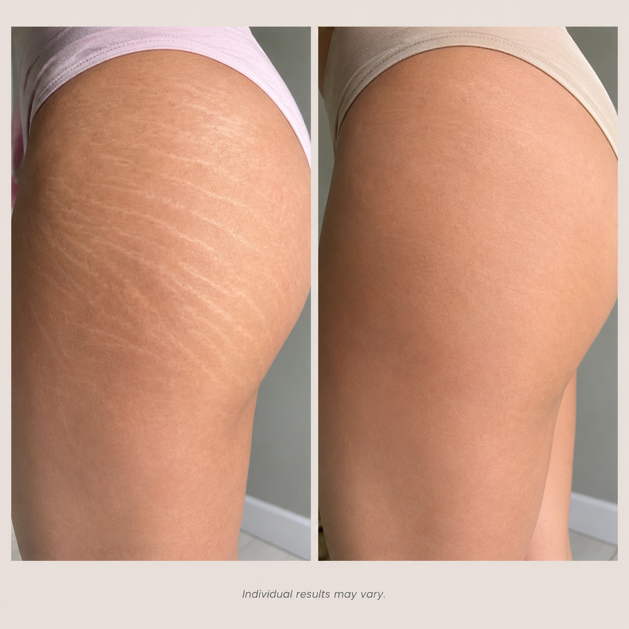 Pro-Grade Anti-Stretch Marks Cream