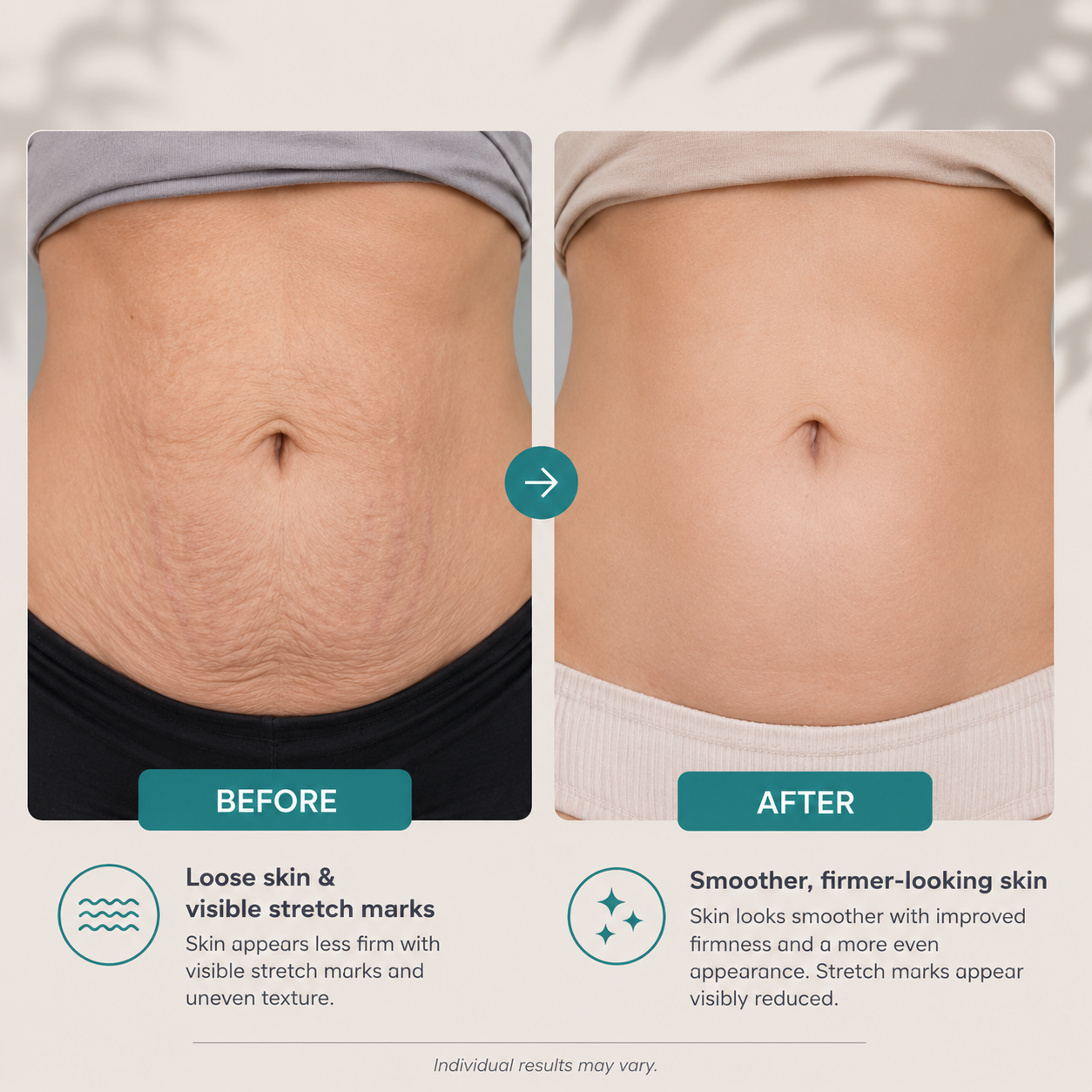 Pro-Grade Anti-Stretch Marks Cream