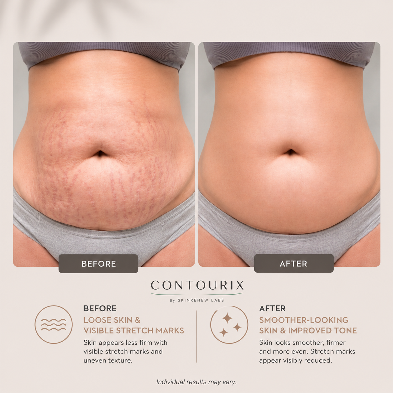 Pro-Grade Anti-Stretch Marks Cream